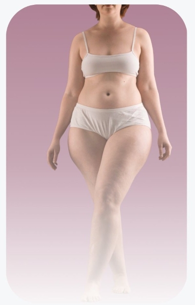 Banner - Verdacht auf Lipödem?