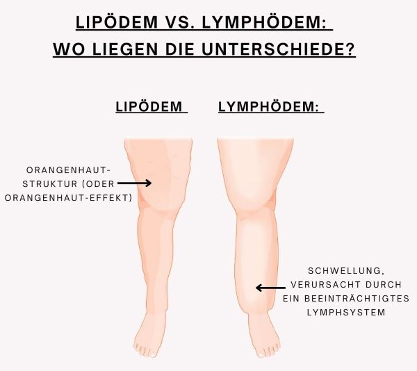 Banner - Verdacht auf Lipödem?